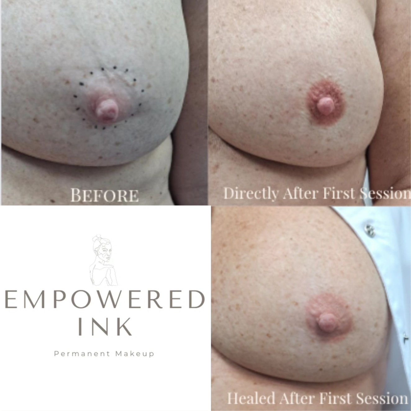 Nipple Tattoos After Mastectomy Photos Gallery